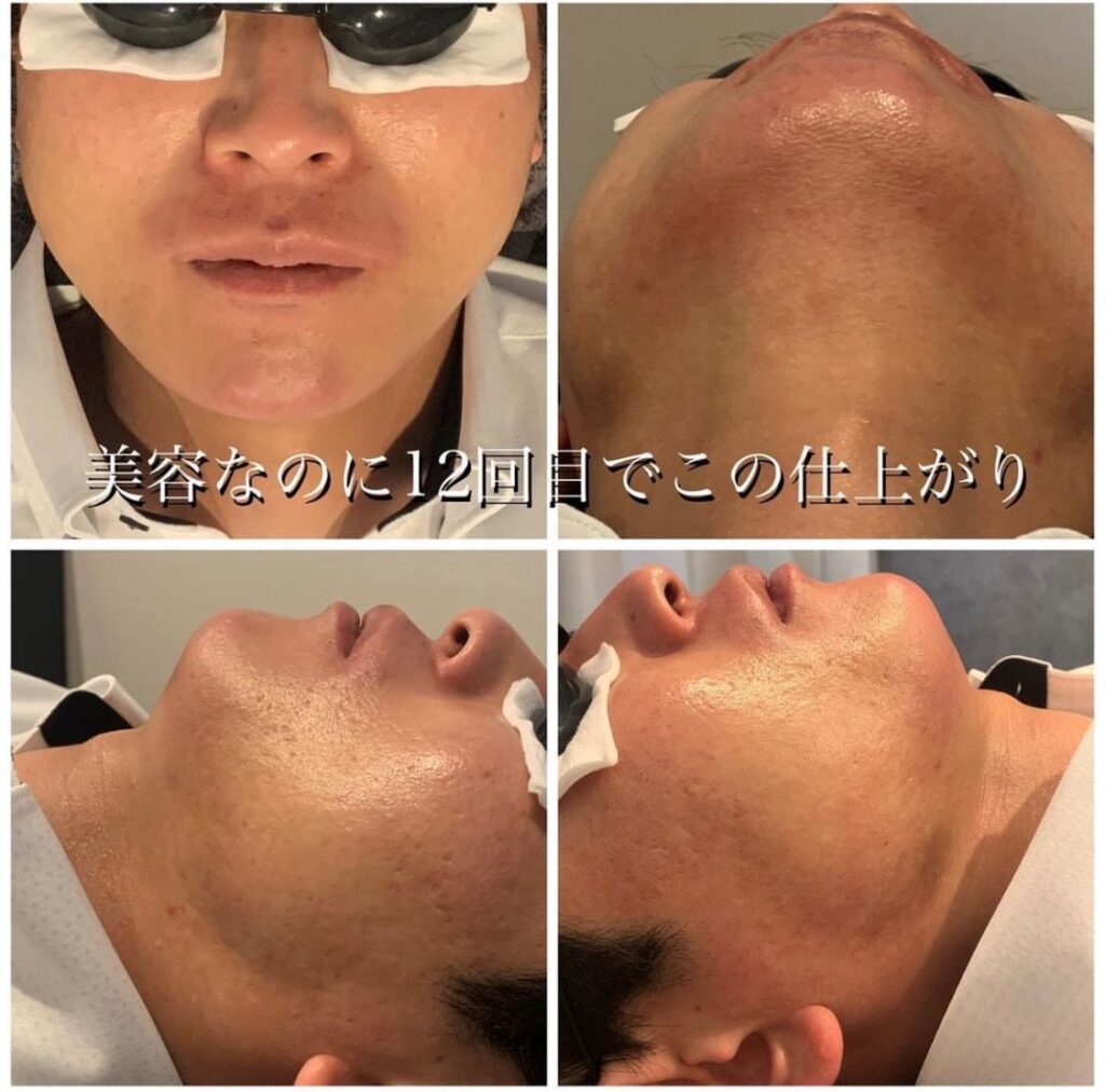 メンズ脱毛、やるなら今！メリットと効果を徹底解説！
